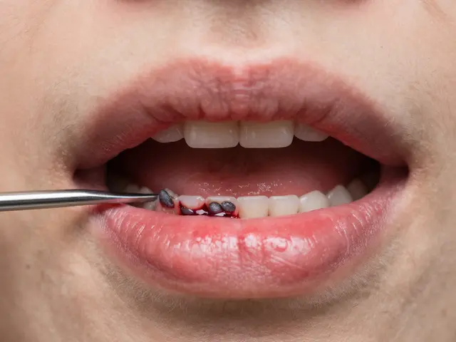 Zubní kámen pod dásní: jak se ho zbavit jednou provždy