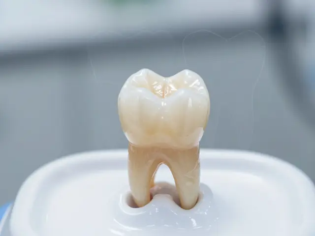 Jak dlouho vydrží zub bez nervu? Vše, co potřebujete vědět o životnosti po kořenové léčbě