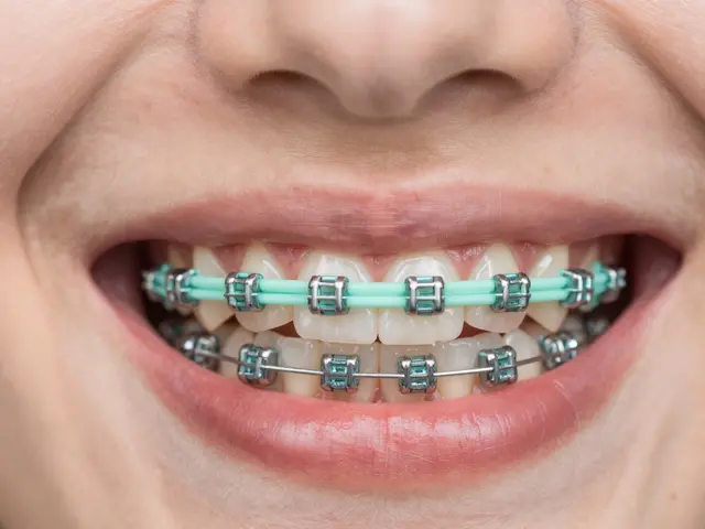 Jakou barvu gumiček na rovnátka vybrat pro maximální efekt?