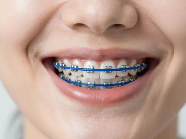 Jak vybrat gumičky na rovnátka: Barvy, typy a praktické tipy